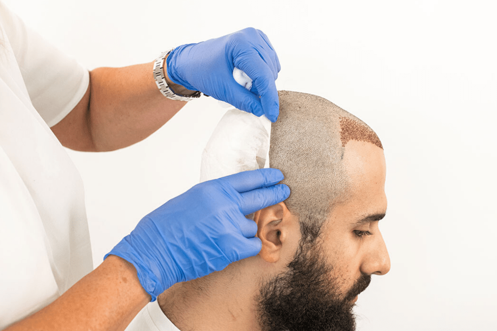 FUT+FUE+BHT Hair Transplant Procedure: Explain The Technique And Its Benefits