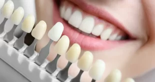 teeth whitening service